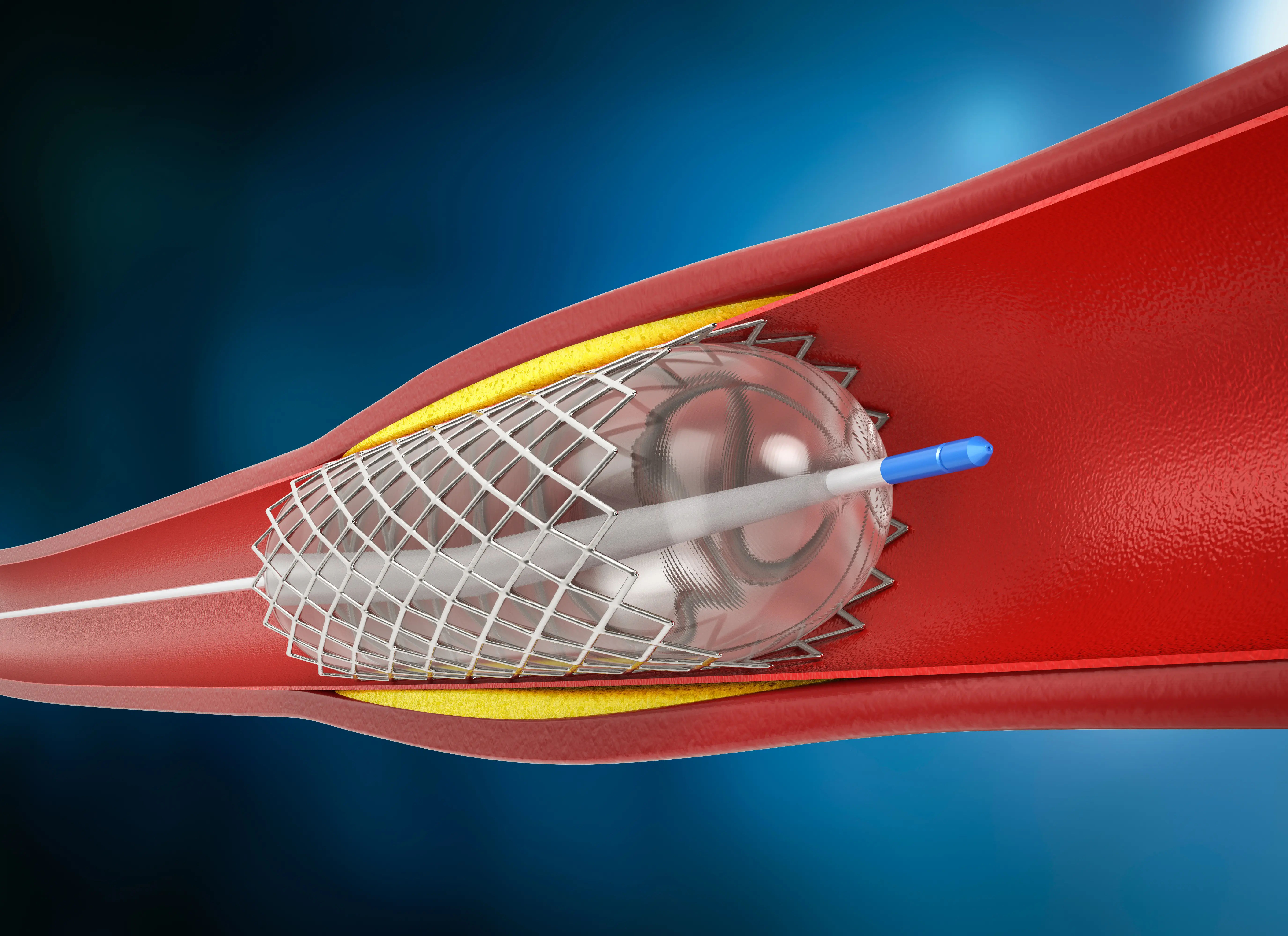 Angioplasty Overview and Related Information
